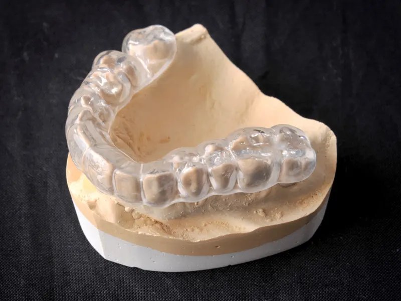 Clear night guard on a dental stone model